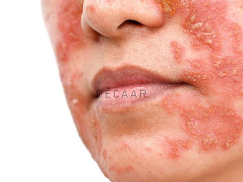 Viêm da nặng hơnKích ứng – dị ứng nghiêm trọng